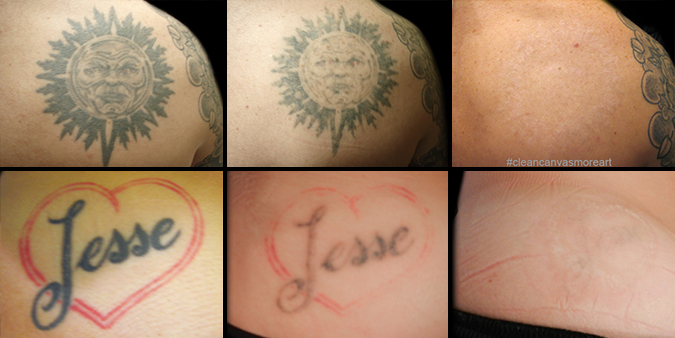 Laser Removal - Lark Tattoo - Lark Tattoo